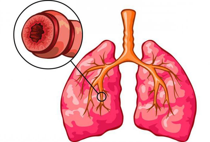 whether they take into the army with bronchial asthma