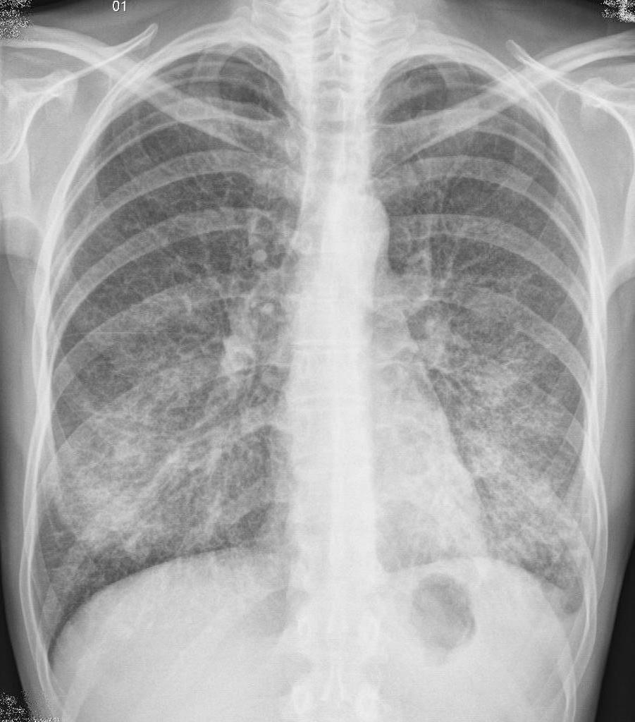 Normes pour le traitement de la pneumonie chez les enfants