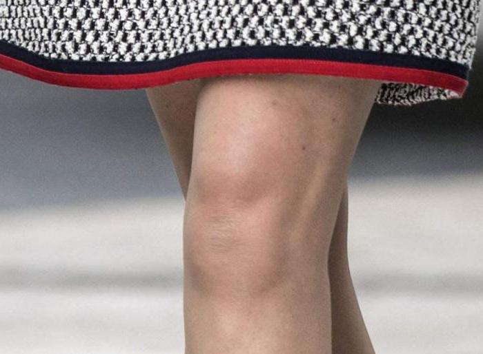  knee replacement